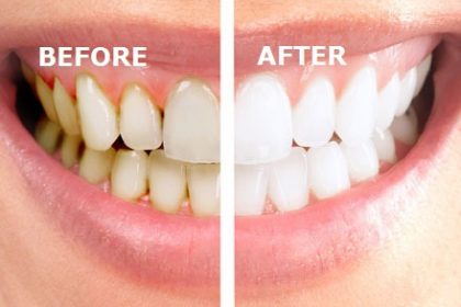 درمان ریشه دندان در قلهک