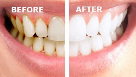 درمان ریشه دندان در تهران درمان ریشه دندان در قلهک