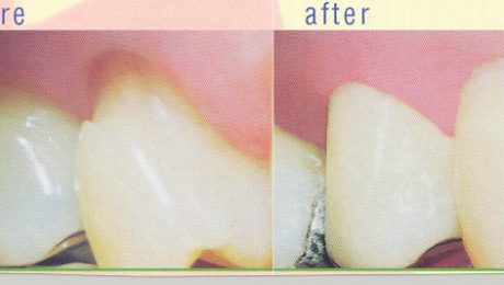 ترمیم اثه در پاسداران ترمیم لثه در بهشتی