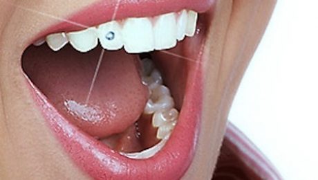 نگین دندان در تهرانپارس نگین دندان در پاسداران