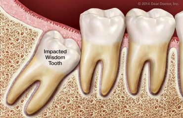 دندانپزشکان ماهر در رابطه با دندان عقل