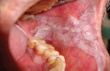 بهداشت دهان و دندان و لکوپلاکیا یا سفیدکژنه ارزانترین دندانپزشکی برای درمان لکوپلاکیا یا سفیدکژنه