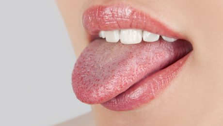 عوامل بیماری زبان سیاه مودار چیست؟ روش درمان بیماری زبان سیاه مودار