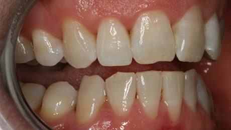 بيماري لثه چيست؟ توصیه های دندانپزشکی برای لثه