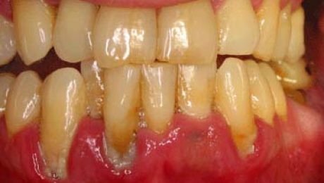 درمان بیماری زبان جغرافیابی در شرق تهران درمان بیماری لثه