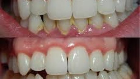 بیماریهای لثه درمان بیماریهای لثه