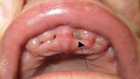حفره-خشک-دندان حفره خشک دندان