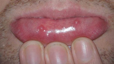 موکوسل موکوسل