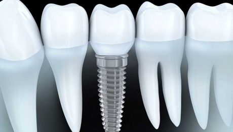ایمپلنت دندان ایمپلنت دندان