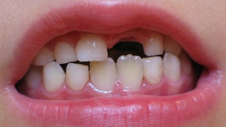 دندان درد کودکان