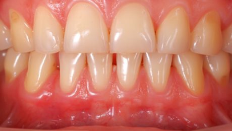 جراحی زیبایی لثه جراحی زیبایی لثه