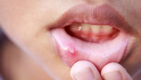 درمان بیماری موکوسل درمان بیماری موکوسل