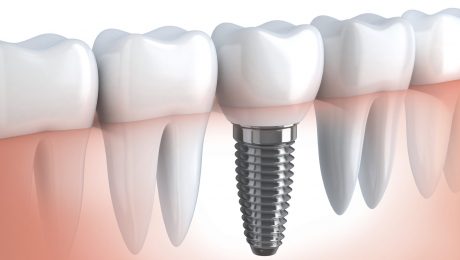مزایای ایمپلنت دندان مزایای ایمپلنت دندان