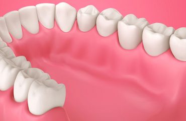 جراحی لثه درد دارد؟ جراحی لثه درد دارد؟