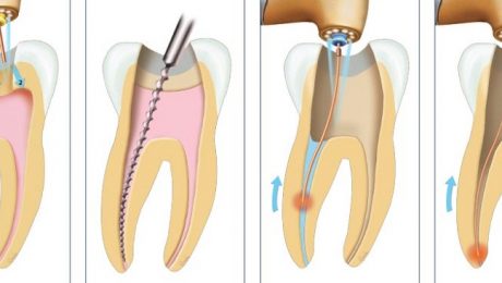 عصب کشی دندان با لیزر عصب کشی دندان با لیزر
