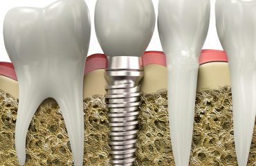 کاشت دندان کاشت دندان