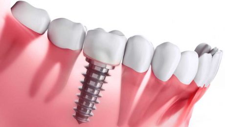 ایمپلنت دندان ایمپلنت دندان