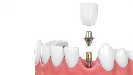 ایمپلنت دندان ایمپلنت دندان