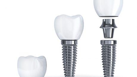ایمپلنت دندان در یک جلسه ایمپلنت دندان در یک جلسه