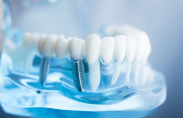 ایمپلنت دندان ایمپلنت دندان