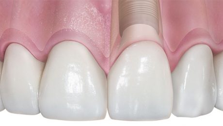 ایمپلنت دندان چقدر طول میکشه ایمپلنت دندان چقدر طول میکشه