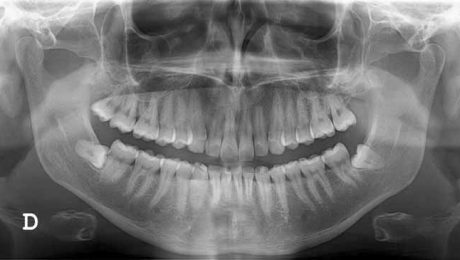 هزینه-عکس-opg-دندان هزینه عکس opg دندان چقدر است؟