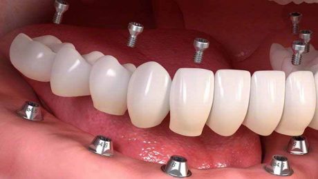 هزینه ایمپلنت دندان در سال جدید