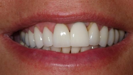 ایمپلنت دندان با لیزر ایمپلنت دندان با لیزر