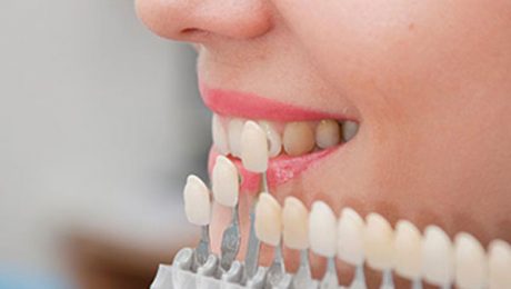 انواع روکش دندان