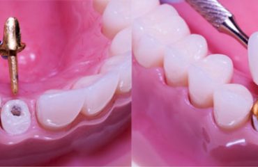 پست و کور دندان پست و کور دندان