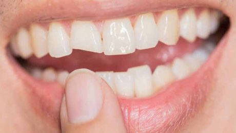 ترمیم-دندان-شکسته-جلو ترمیم دندان شکسته جلو