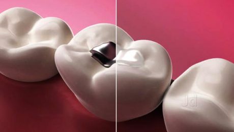 پر-کردن-دندان-با-مواد-سیاه-و-سفید پر کردن دندان با مواد سیاه و سفید