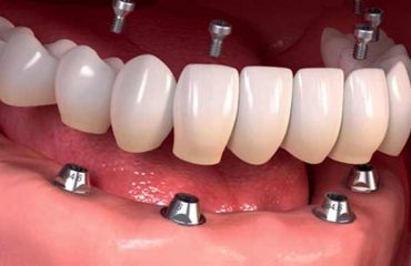 ایمپلنت-دندان ایمپلنت دندان