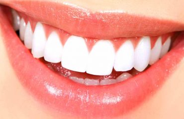 کانتورینگ-لثه-چیست؟ کانتورینگ لثه