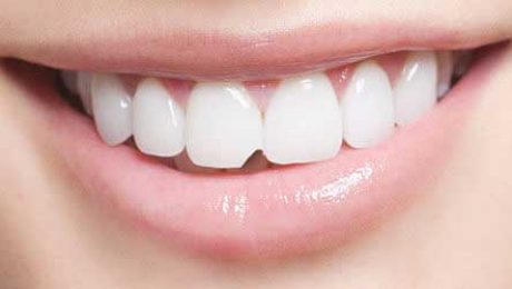 کامپوزیت-دندان-های-جلو کامپوزیت دندان های جلو