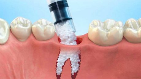 پیوند-استخوان-ایمپلنت پیوند استخوان ایمپلنت دندان