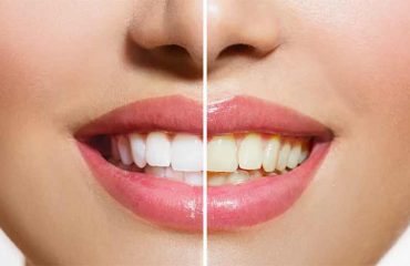 تغییر-رنگ-کامپوزیت-دندان تغییر رنگ کامپوزیت دندان