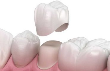 انواع-روکش-دندان انواع روکش دندان