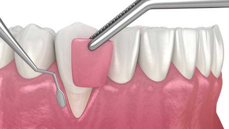 تعرفه جراحی لثه