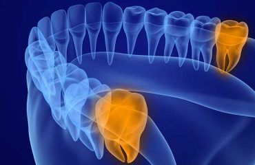 دندان-عقل-چه-فایده-ای-دارد؟ دندان عقل چه فایده ای دارد؟