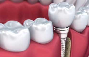 هزینه روکش ایمپلنت