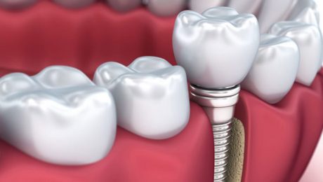 هزینه روکش ایمپلنت