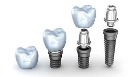 ایمپلنت در ملاصدرا