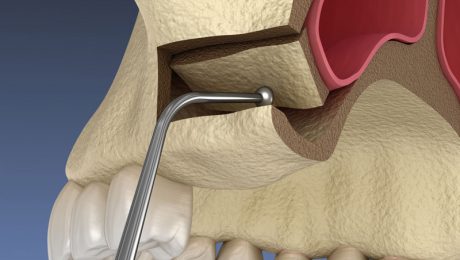 جراحی سینوس لیفت در تهران جراحی سینوس لیفت در تهران