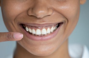 لیفت زیبایی لثه در تهران لیفت زیبایی لثه در تهران