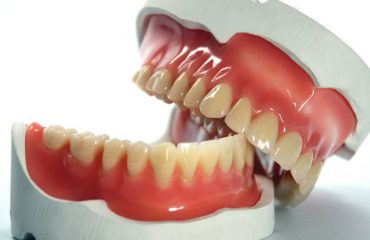 پروتز دندان در تهران