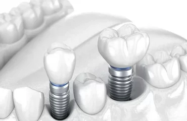 روکش ایمپلنت دندان در تهران روکش ایمپلنت دندان در تهران