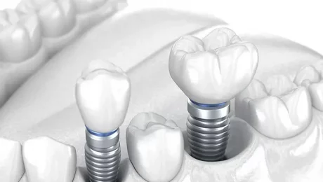 روکش ایمپلنت دندان در تهران روکش ایمپلنت دندان در تهران