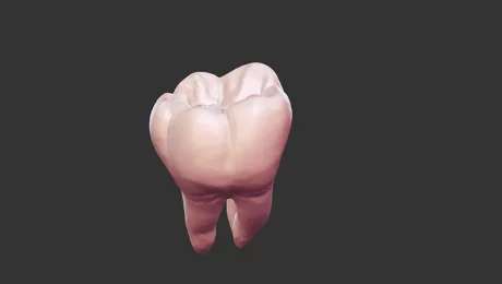 ایمپلنت دندان آسیاب در تهران