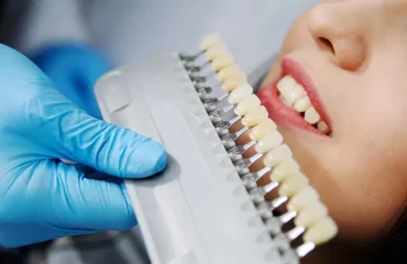 روکش دندان در تهران روکش دندان در تهران